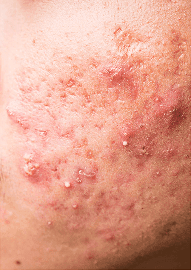 Acne and comedonal disease​