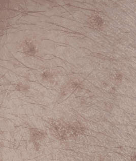 Disseminated Superficial Actinic Porokeratosis​