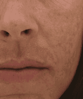Melasma and dyschromia​