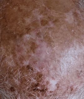 Actinic damage support programmes