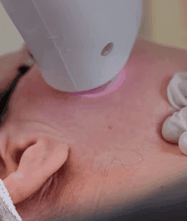 Maintenance regimens following procedural dermatology​